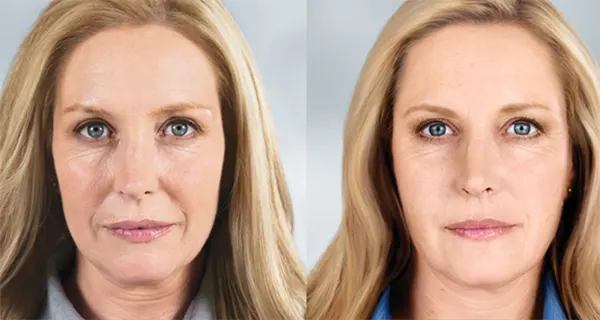bioestimulador de colágeno antes e depois