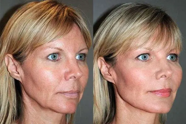 Fios PDO antes e depois