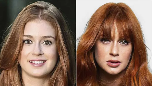 harmonização facial antes e depois